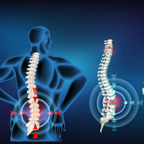 Exploring the Role of Chiropractic Care in Treating Herniated Discs